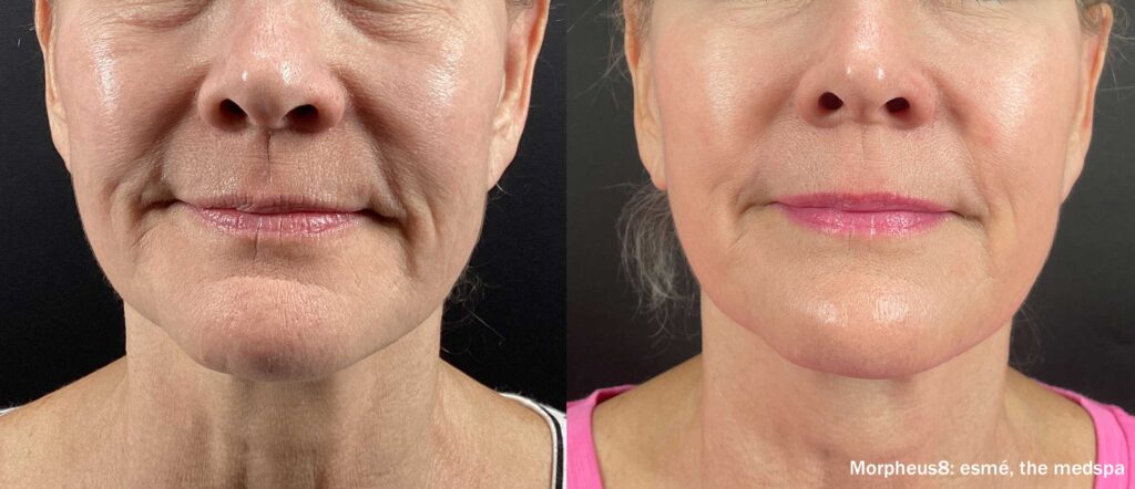 Morpheus8 Face & Body Morpheus8 Face & Body