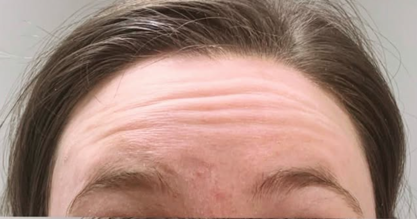 botox- before image
