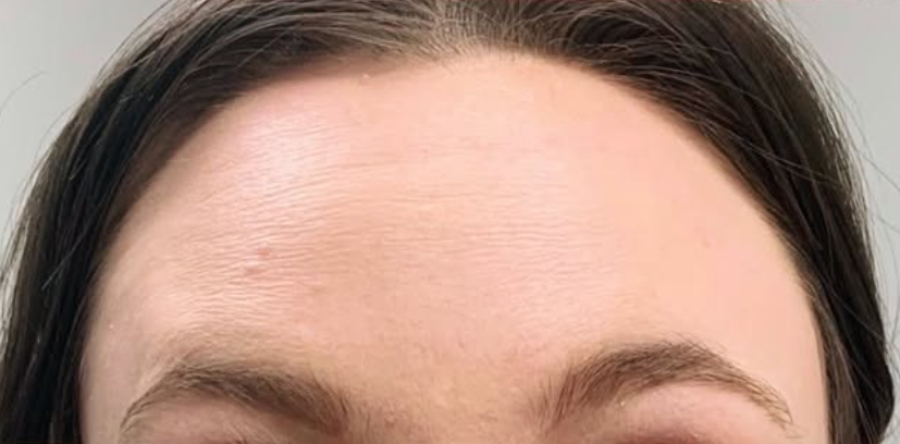 botox after image