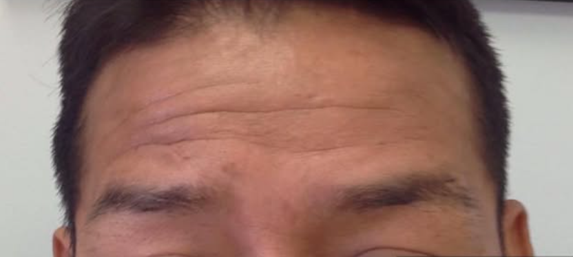 before botox results