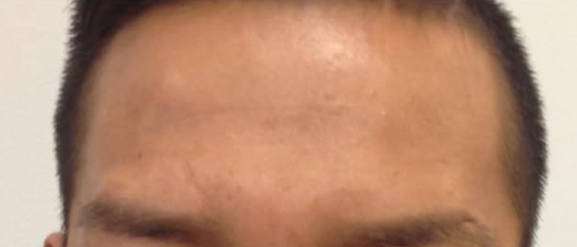 after botox results