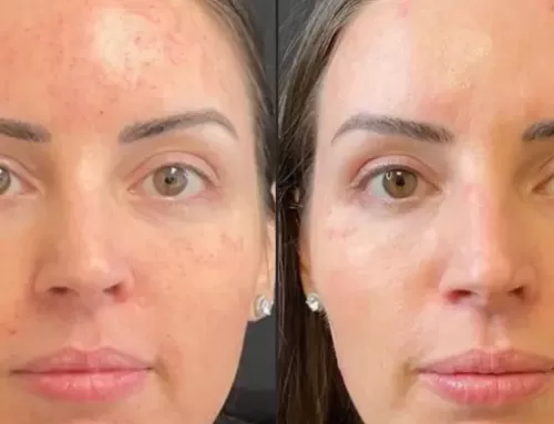 A Patient Came In Wanting Botox. We Recommended Morpheus8 Instead. Here’s Why.