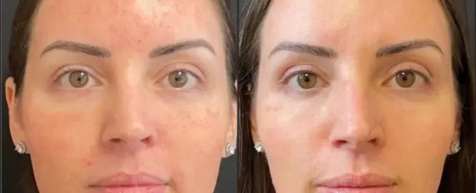 A Patient Came In Wanting Botox. We Recommended Morpheus8 Instead. Here's Why.