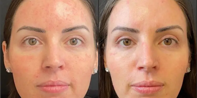 A Patient Came In Wanting Botox. We Recommended Morpheus8 Instead. Here's Why.