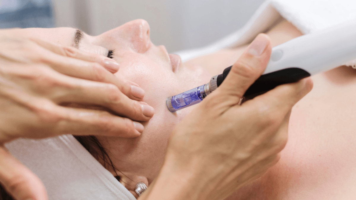 Close-up of microneedling treatment being performed on a woman's cheek at Elite Med Spa in Berwyn