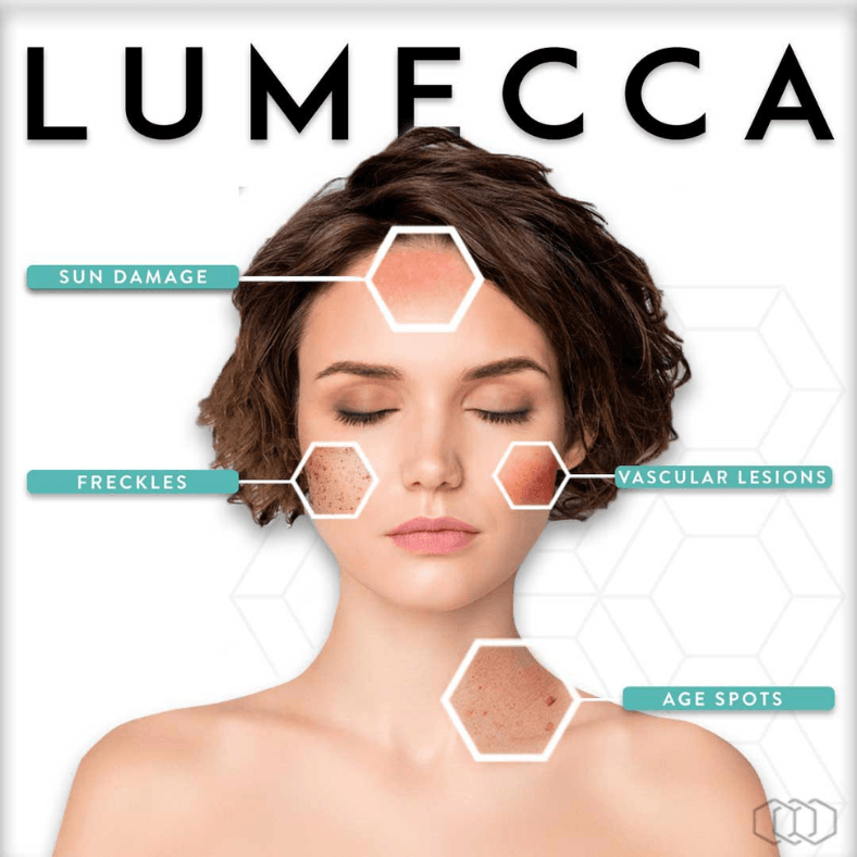 Lumecca IPL treatment at Elite Med Spa Berwyn