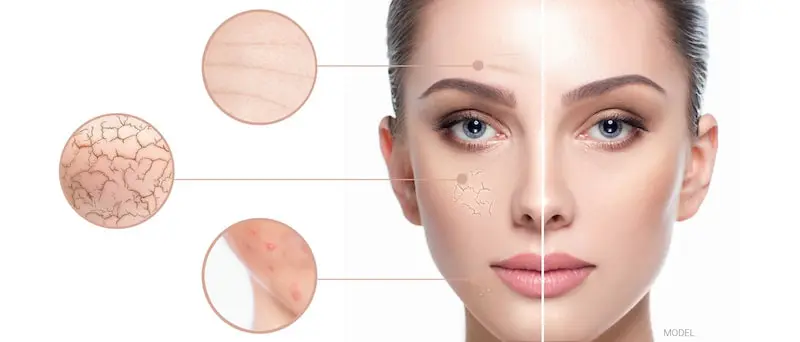 BBL skin rejuvenation recovery and results in Berwyn