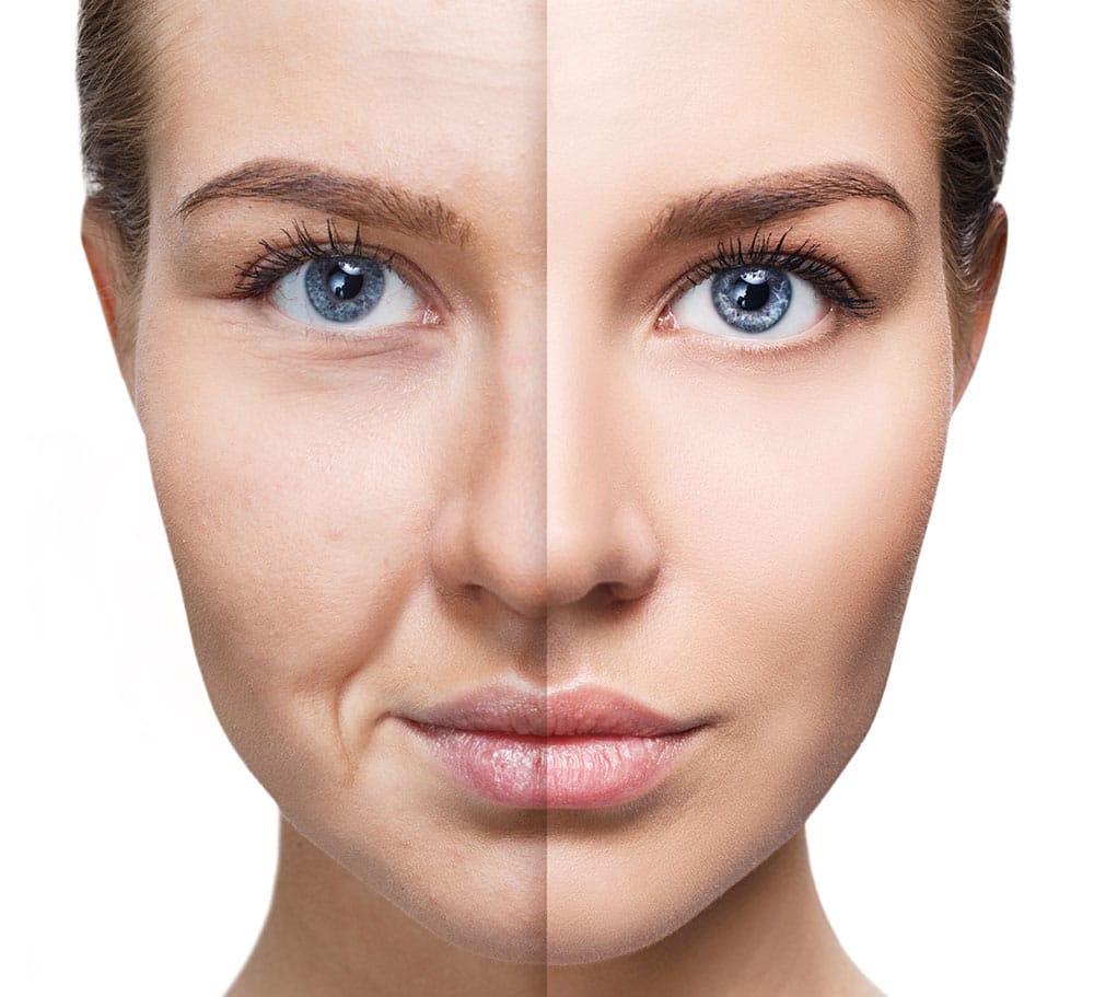 BBL skin rejuvenation before and after results
