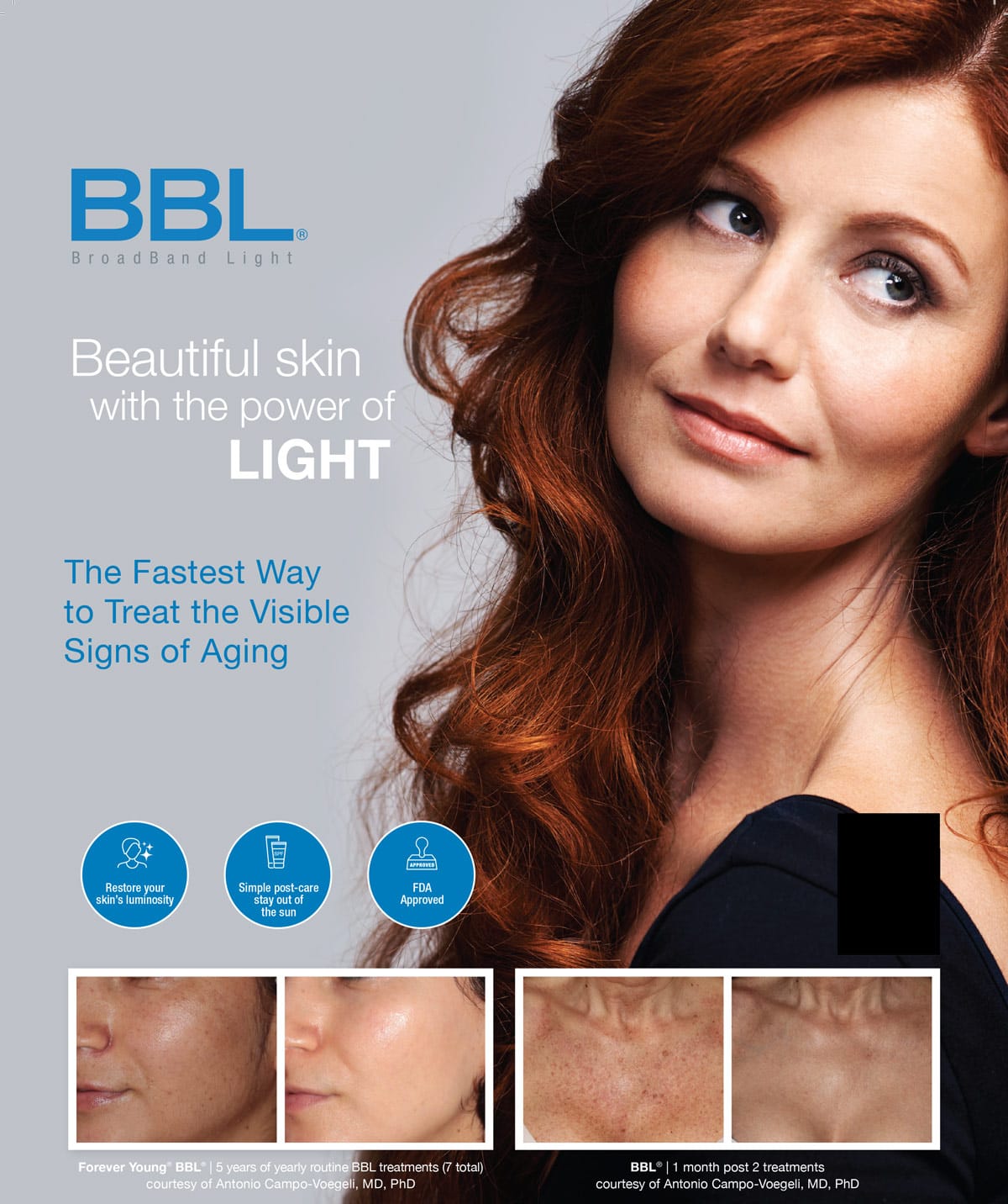 BBL photofacial before and after pigmentation improvement
