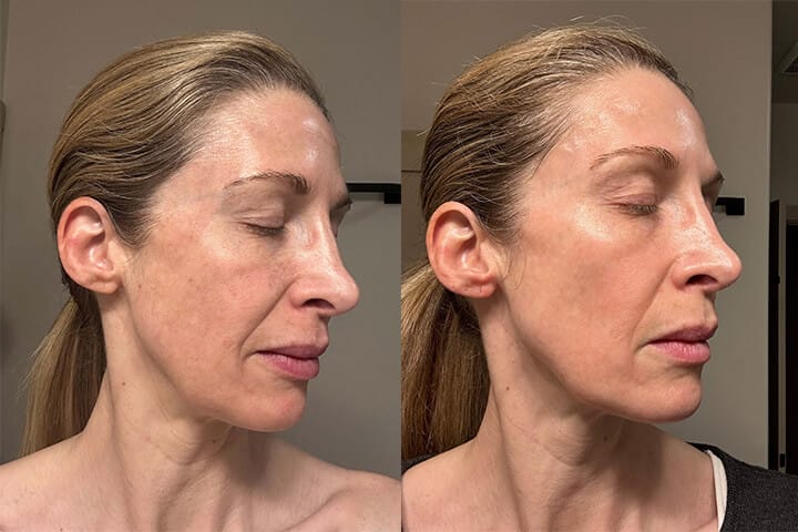 Chemical peel before and after results