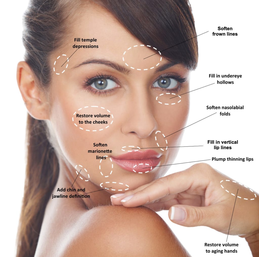 Dermal filler treatment areas on the face