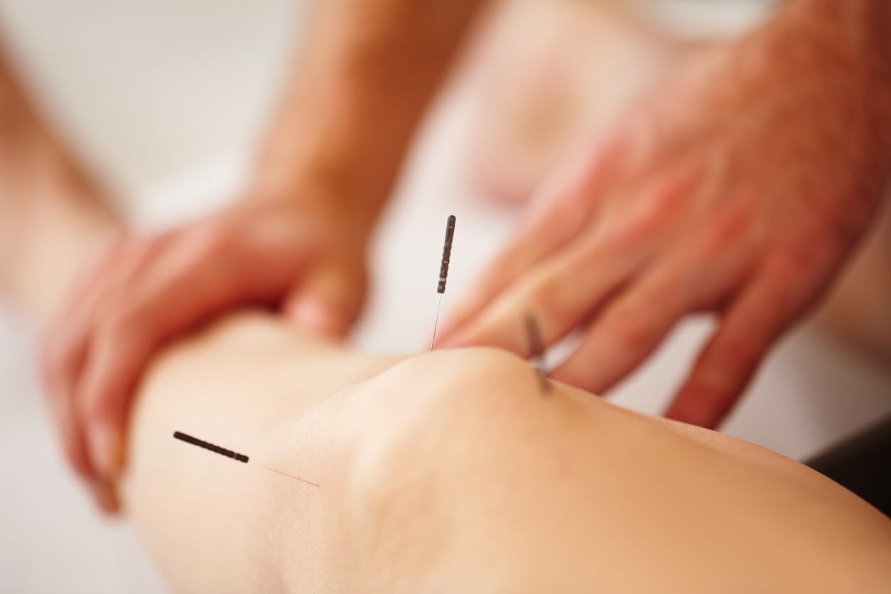 Integrative dry needling for pain relief and healing in Berwyn