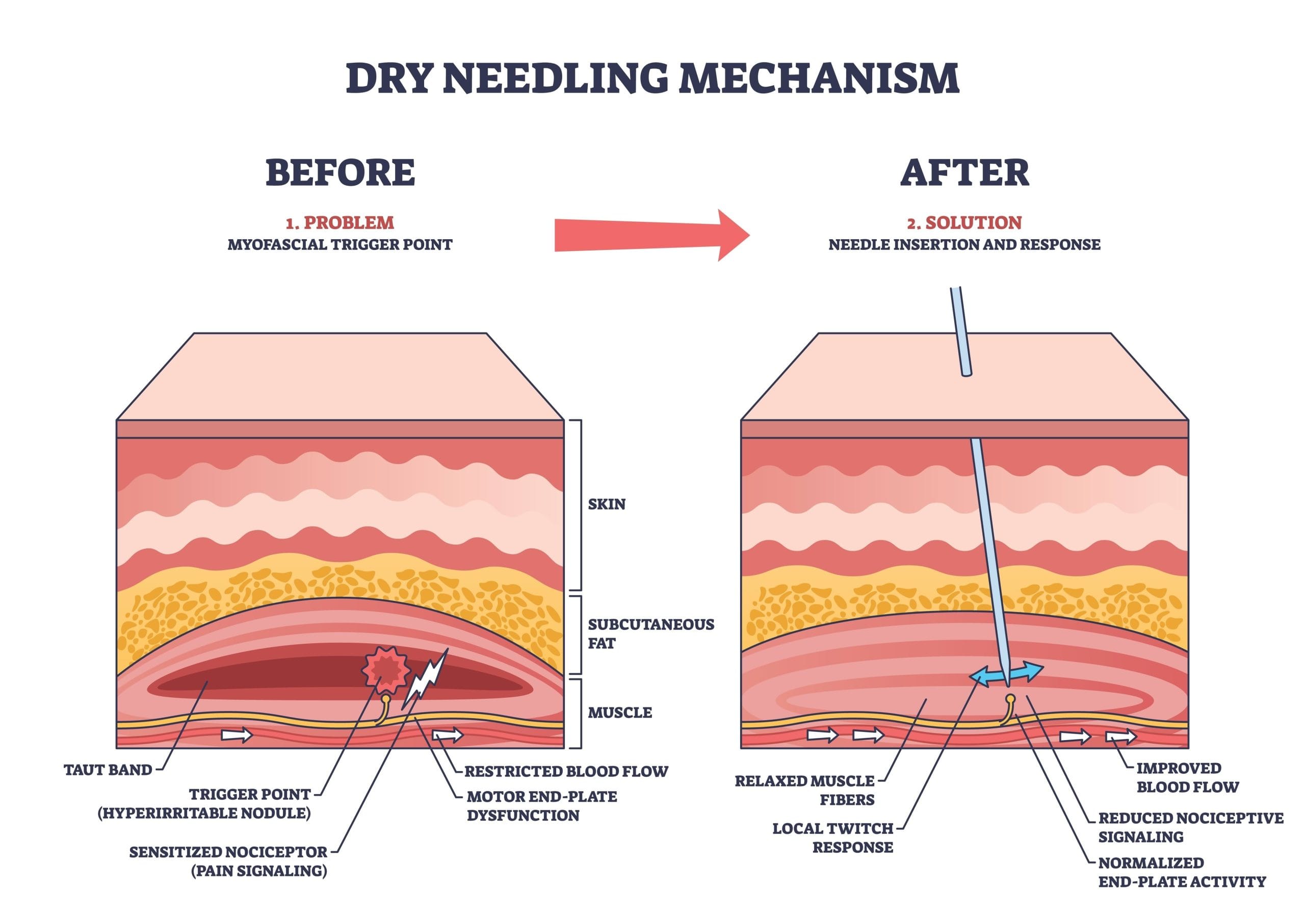 How dry needling targets muscle trigger points