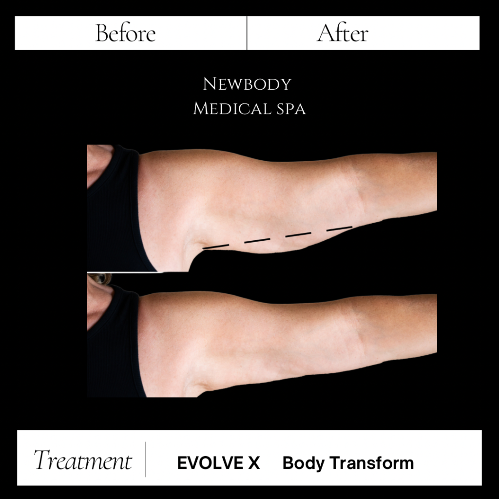 EvolveX arm before and after results