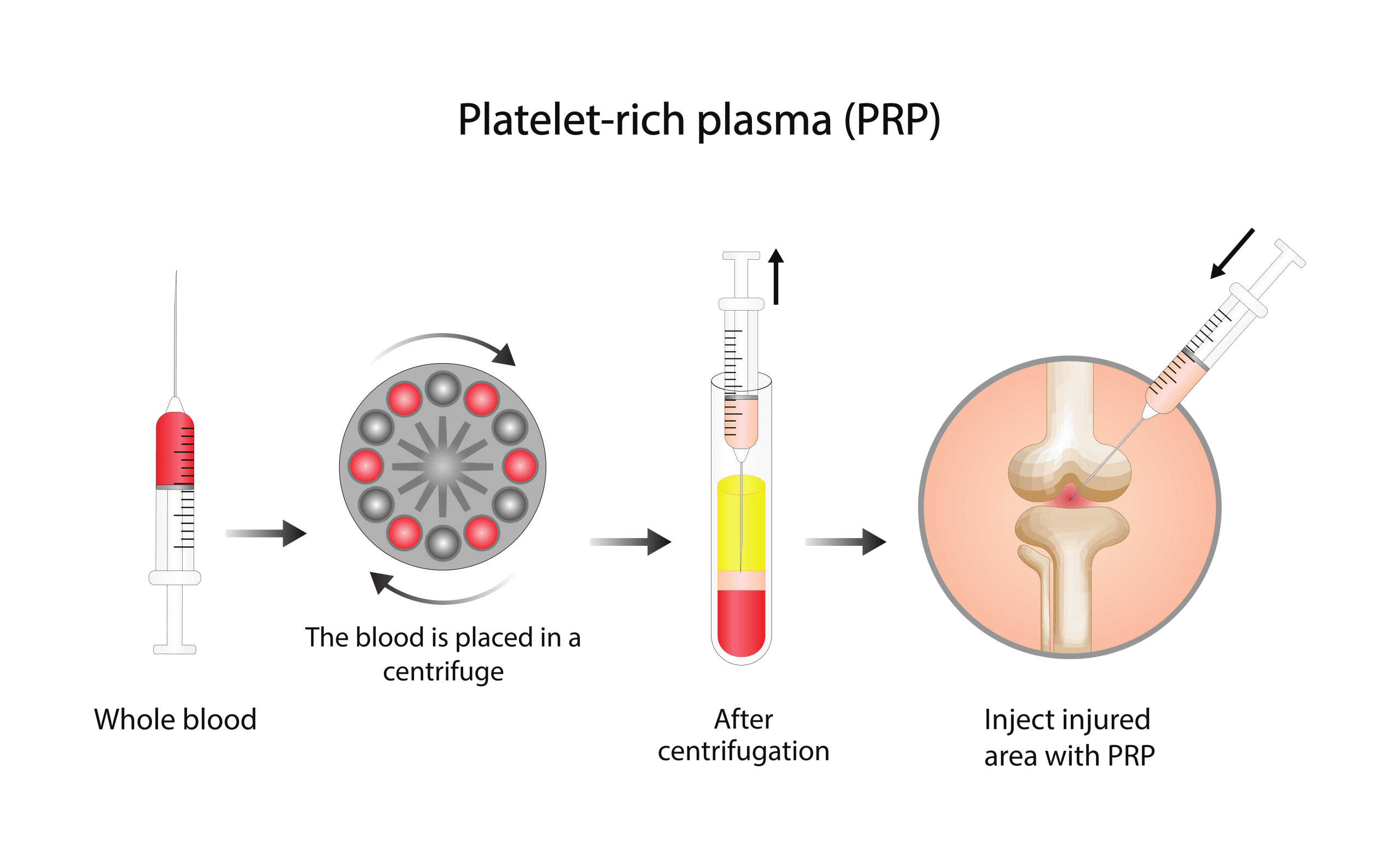 How PRP therapy works diagram