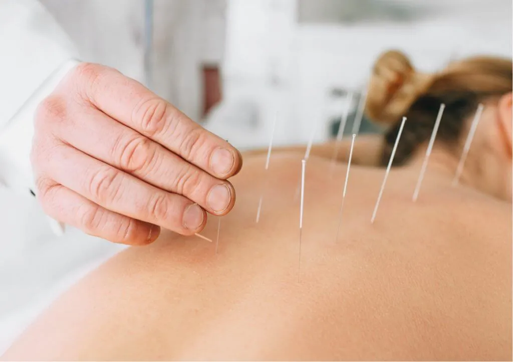 Integrative dry needling treatment session