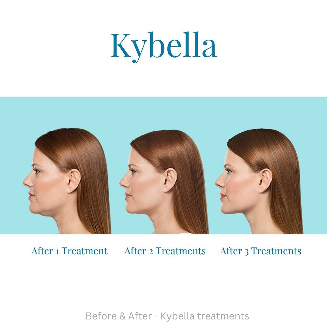 Kybella before and after results