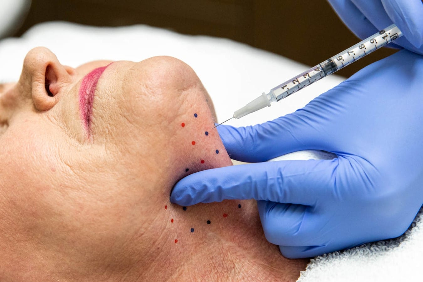Kybella chin sculpting candidate in Berwyn