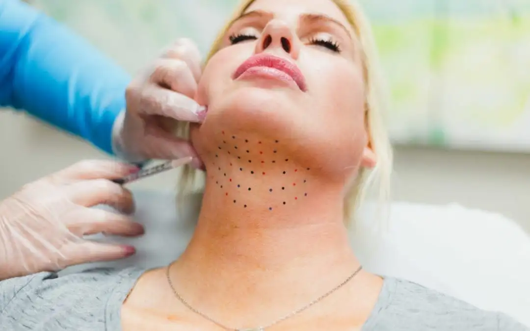 Kybella treatment in progress