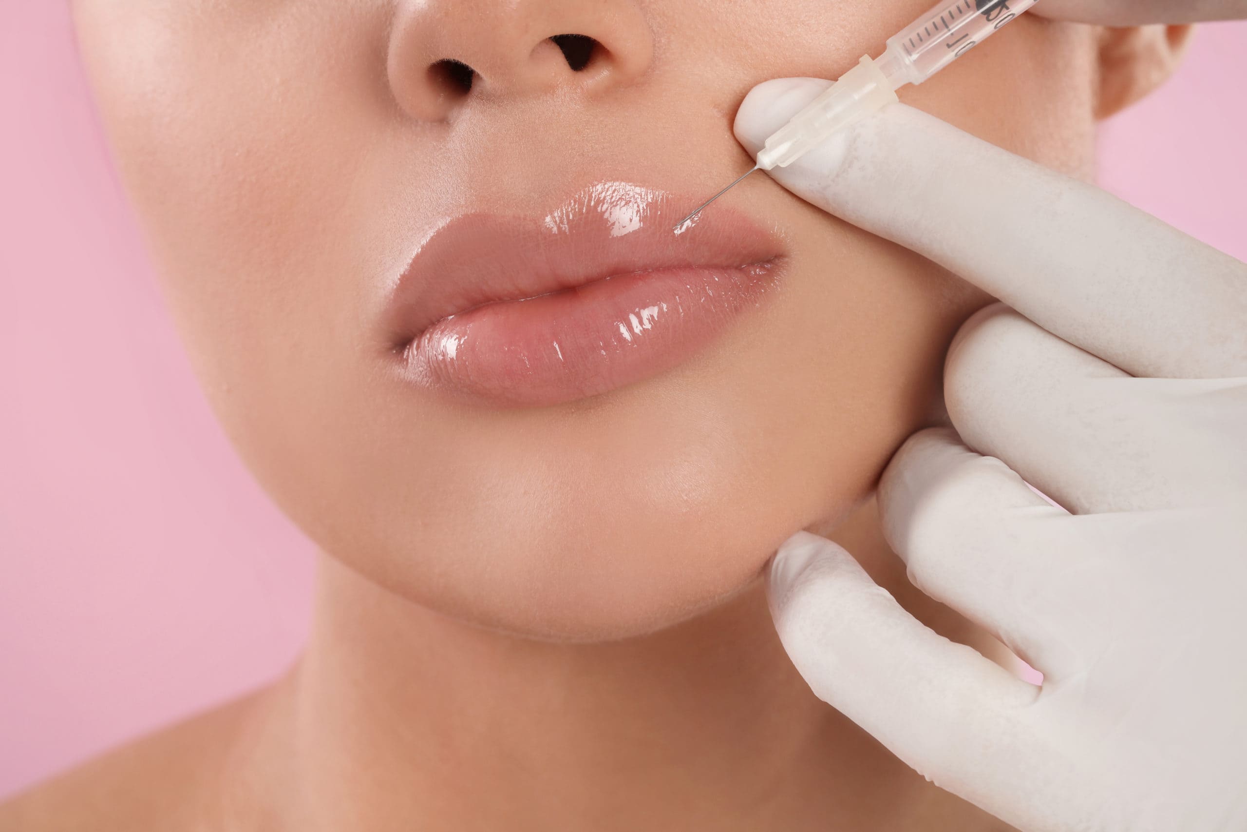 Lip fillers at Elite Med Spa Berwyn