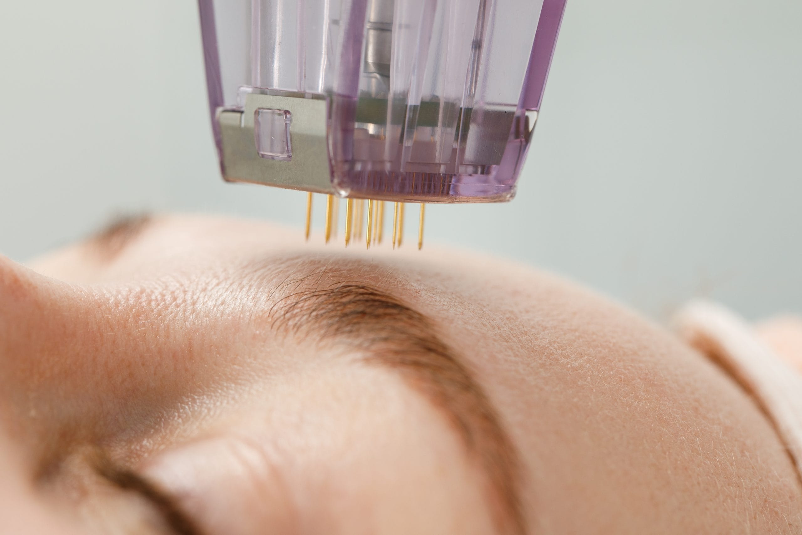 Morpheus8 Burst for facial rejuvenation
