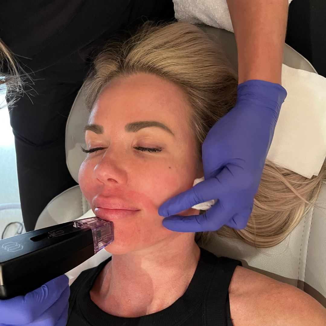 Areas Morpheus8 can treat on the face and body