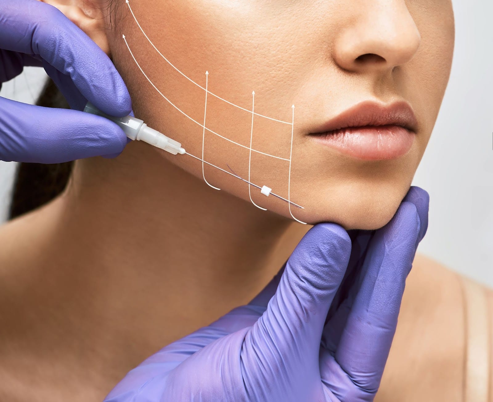 PDO polydioxanone thread lift treatment