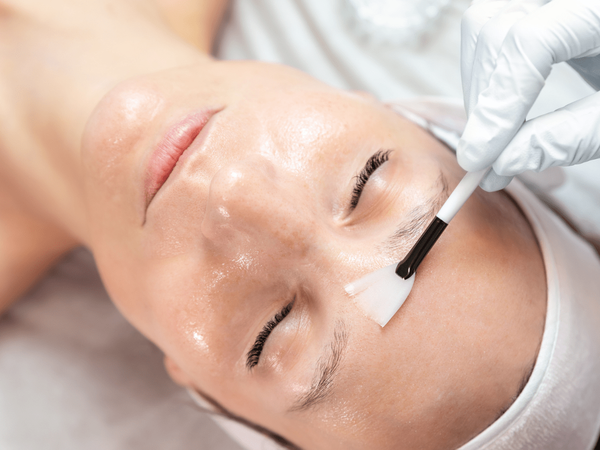 How chemical peels exfoliate and renew the skin