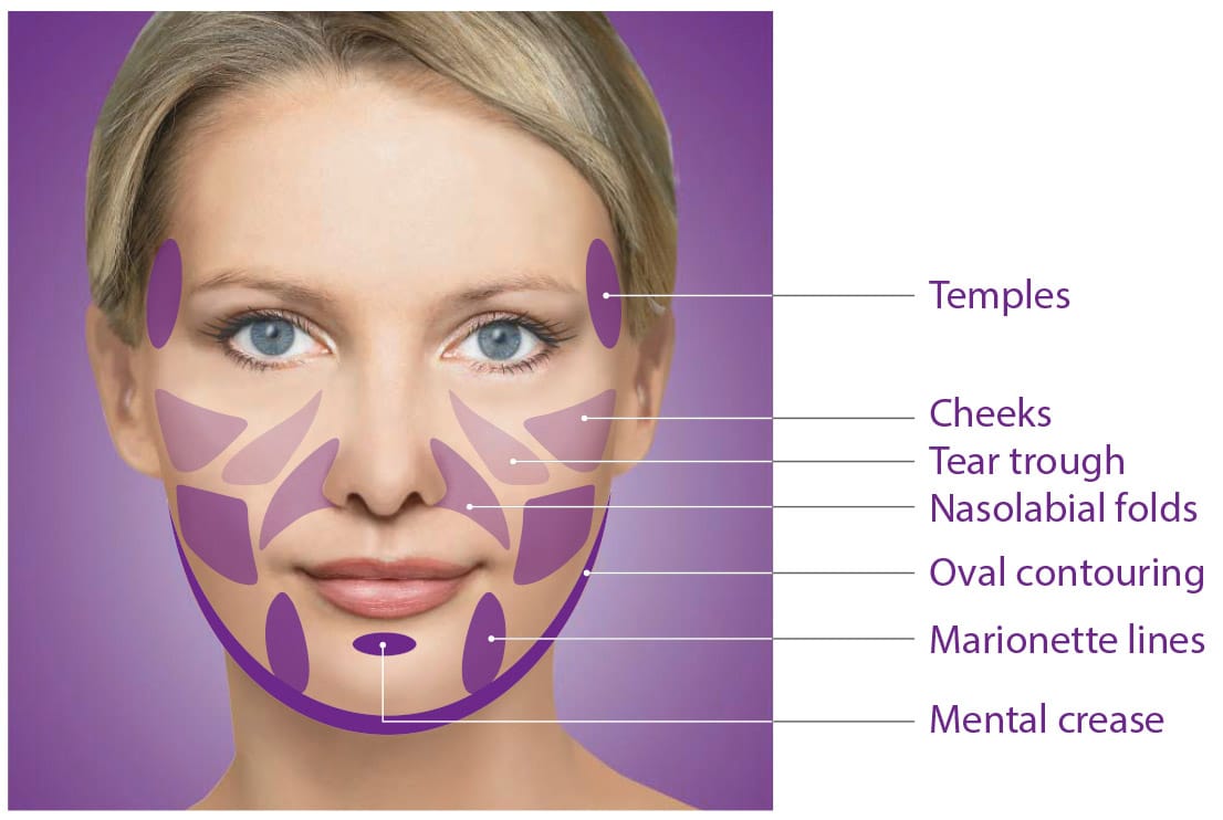 Benefits of Sculptra treatment