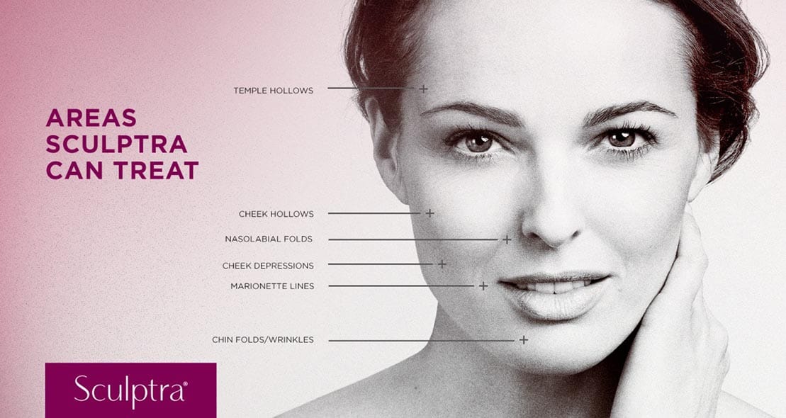 Sculptra collagen-boosting dermal filler in Berwyn