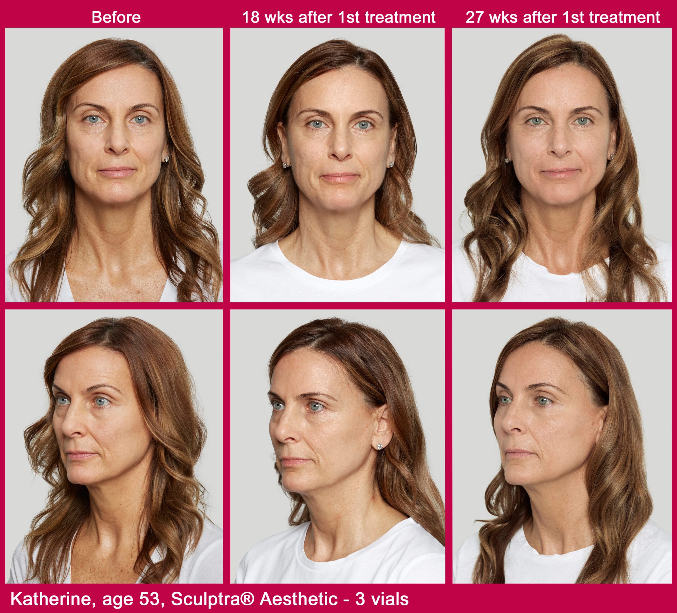 Sculptra before and after results
