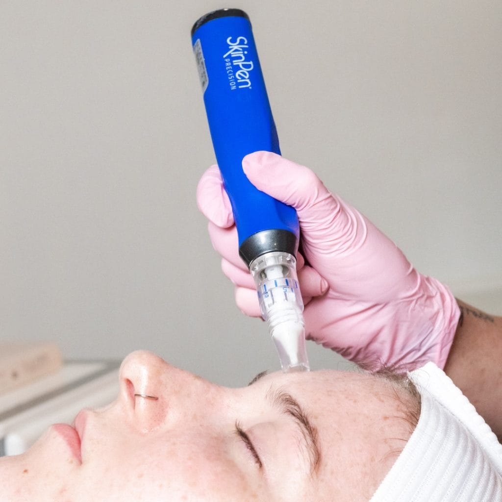 SkinPen microneedling in Berwyn