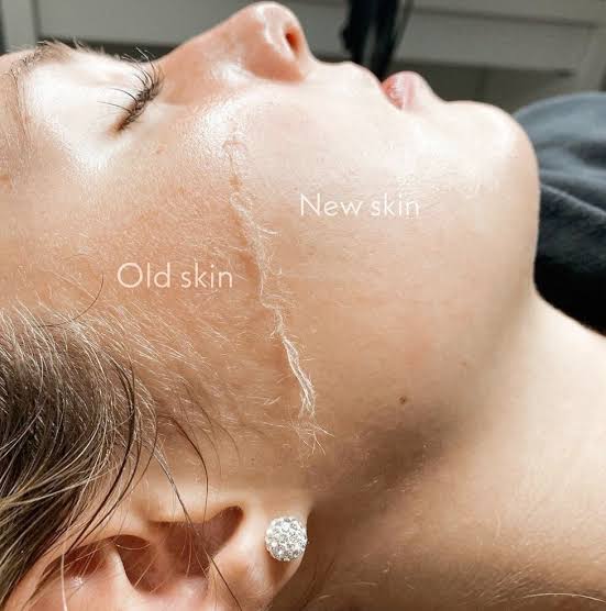 Close-up of a sterile scalpel performing dermaplaning exfoliation