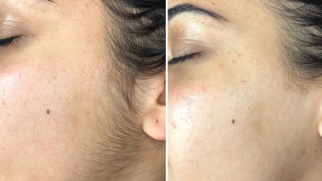 Smooth, glowing skin after a dermaplaning treatment