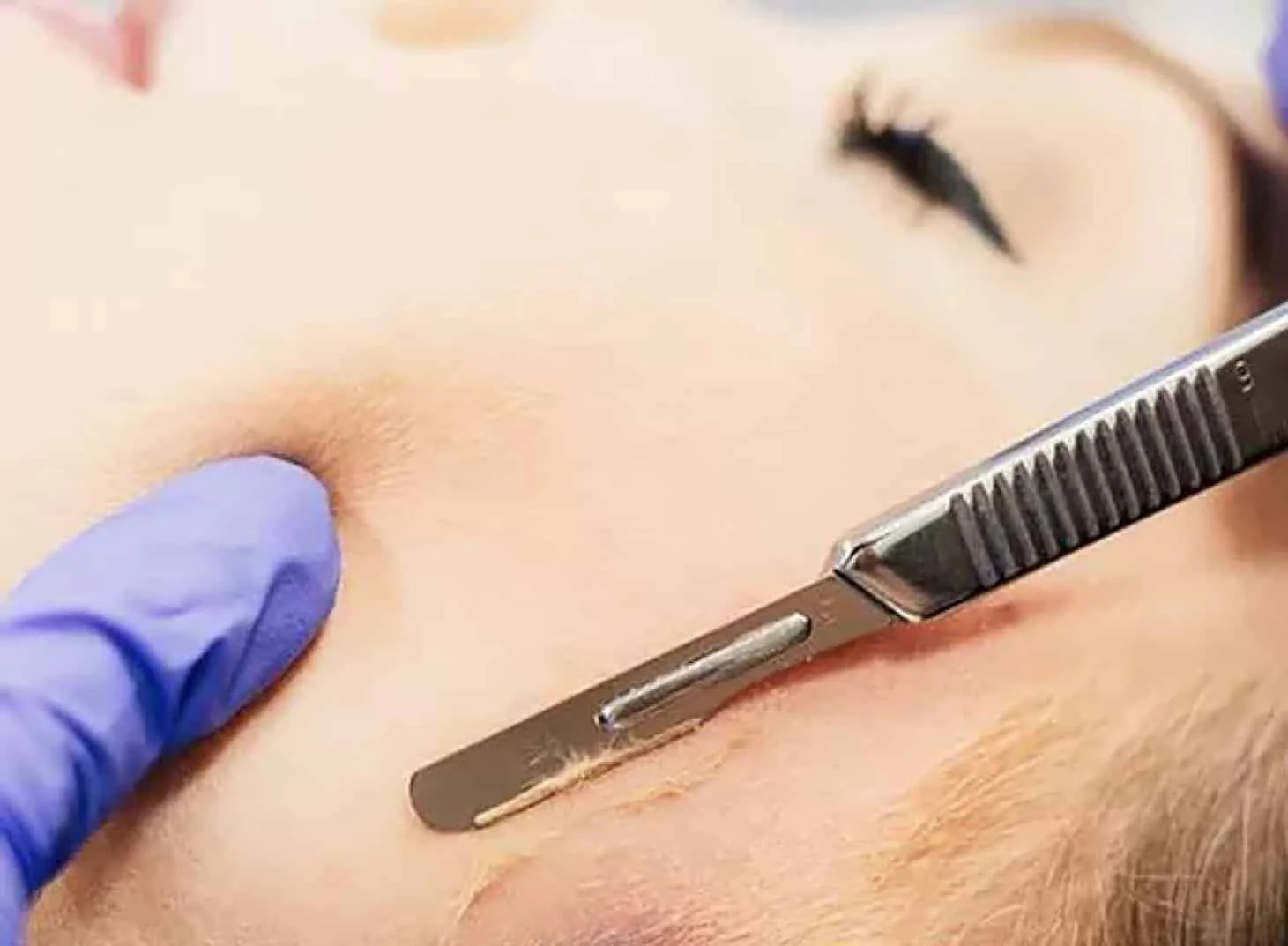 Provider performing dermaplaning treatment at Elite Med Spa in Berwyn, Illinois