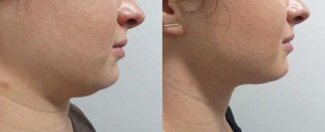 kybella-double-chin-treatment-before-after